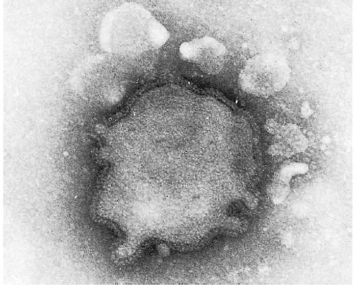 Parainfluenza type 3 infection