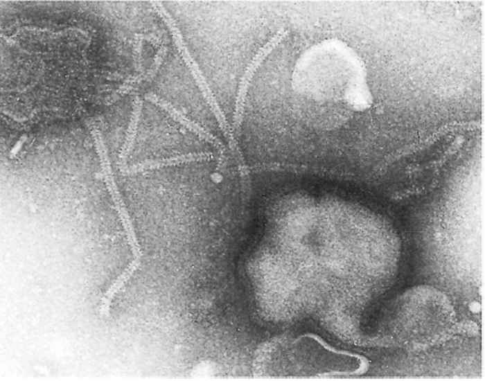 Parainfluenza type 3 infection