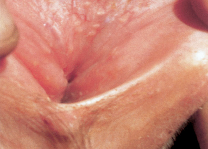 Infectious bovine rhinotracheitis/infectious pustular vulvovaginitis and infectious pustular balanoposthitis