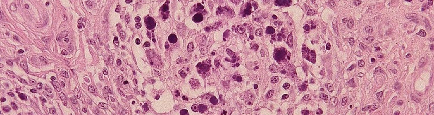 Post-weaning multi-systemic wasting syndrome in swine