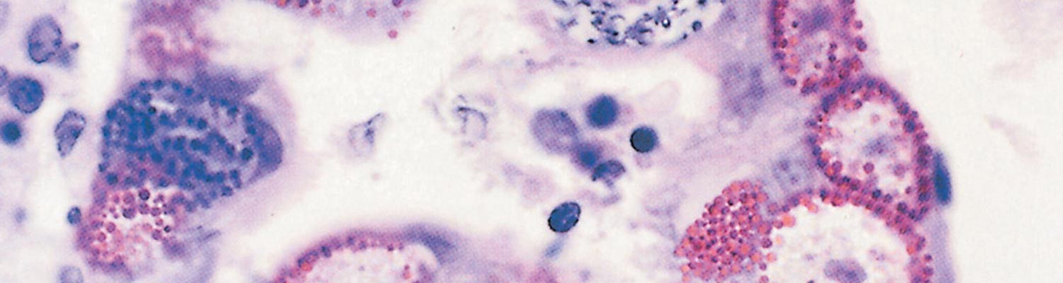 Coccidiosis
