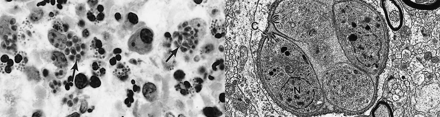 Toxoplasmosis