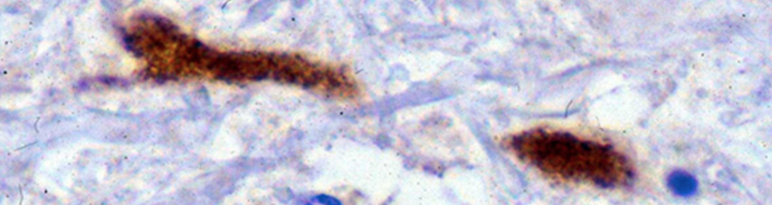 West Nile virus infection