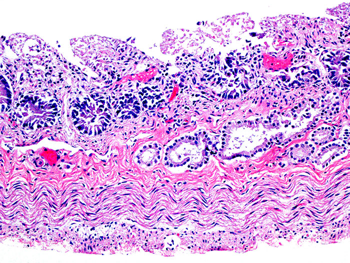 Necrotic small intestine in a lamb with Clostridium perfringens type B enterotoxaemia