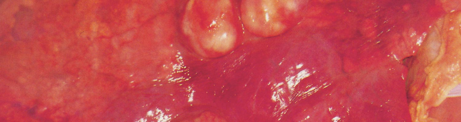 Rhodococcus equi infections