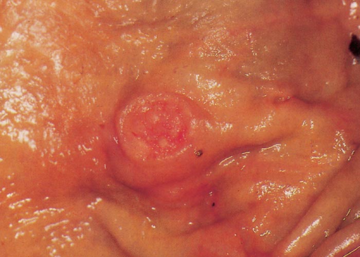 Rhodococcus equi infections