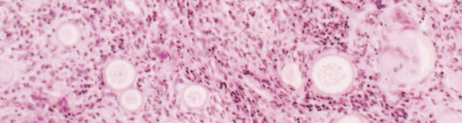 Mycoses