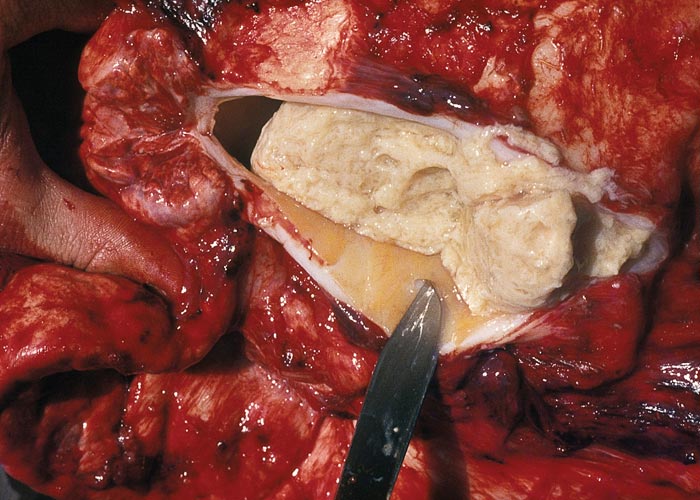 Contagious bovine pleuropneumonia