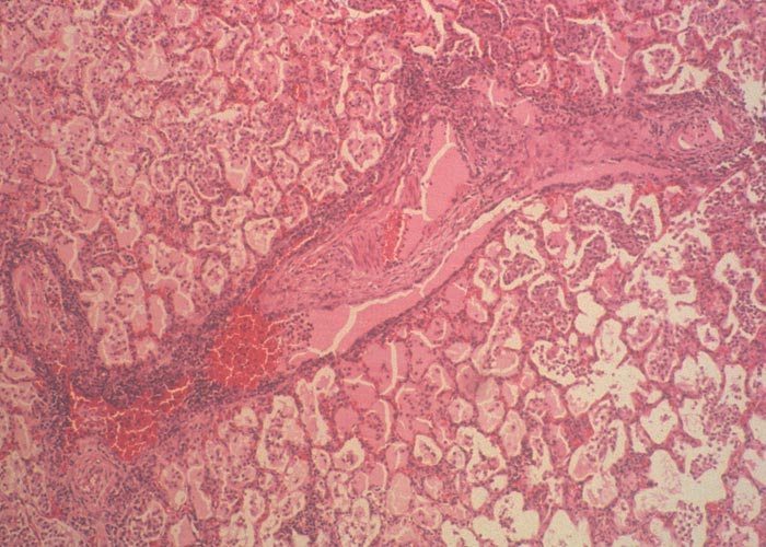 Contagious bovine pleuropneumonia