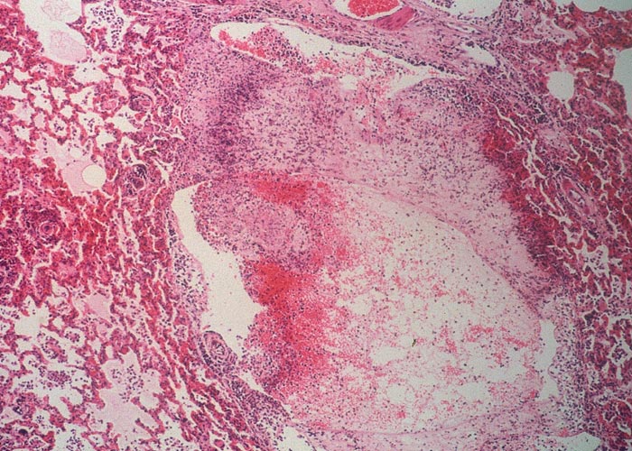 Contagious bovine pleuropneumonia