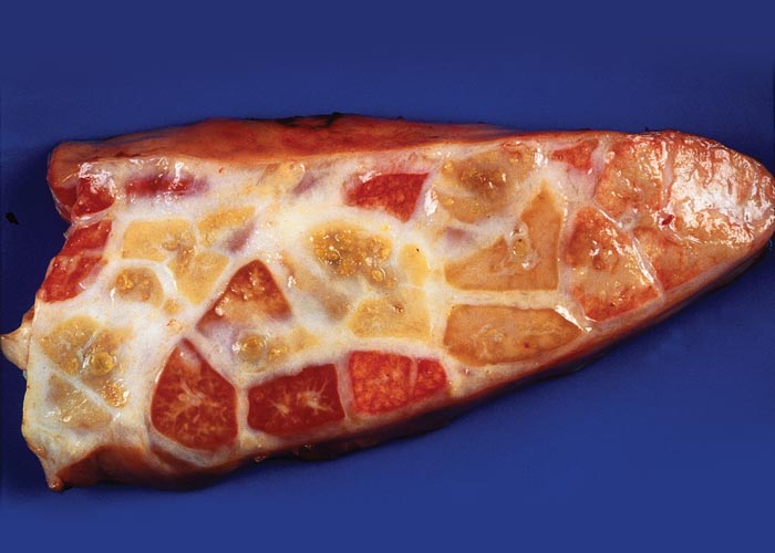 Contagious bovine pleuropneumonia